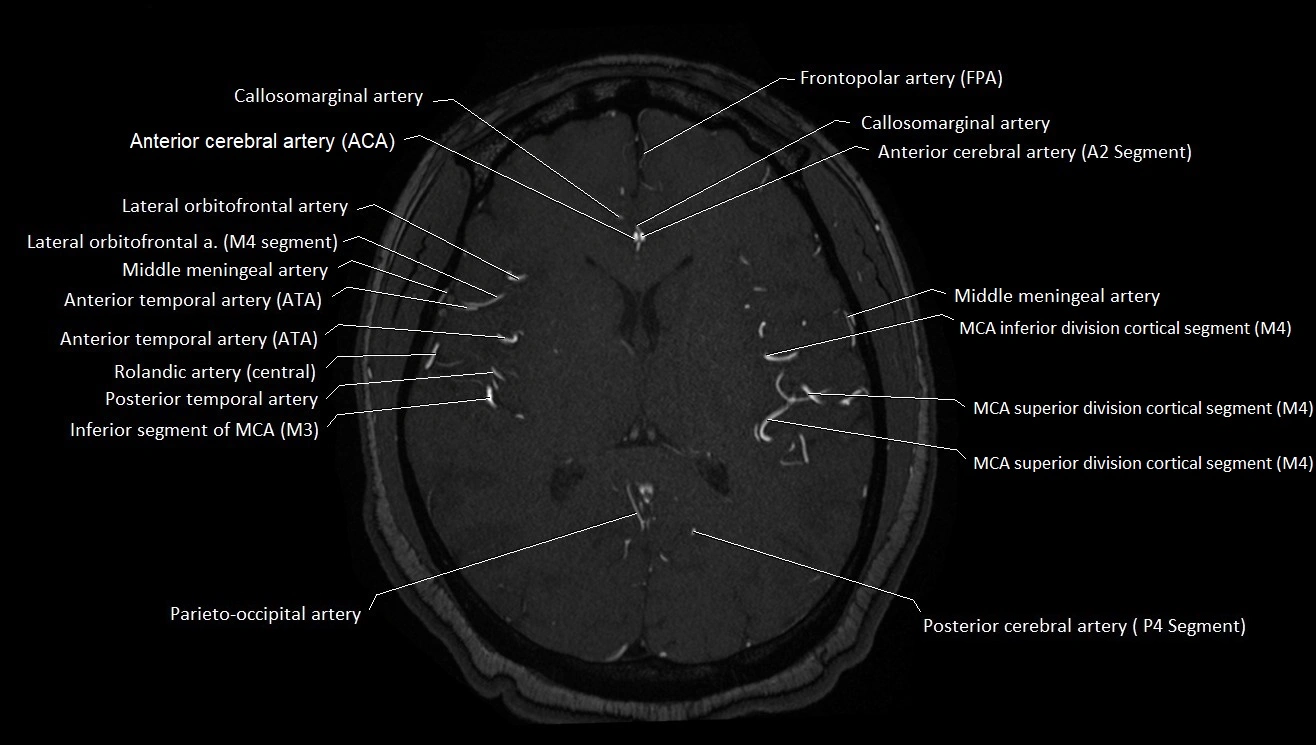 MRA brain (cerebral arteries) anatomy axial 3T image 31.webp
